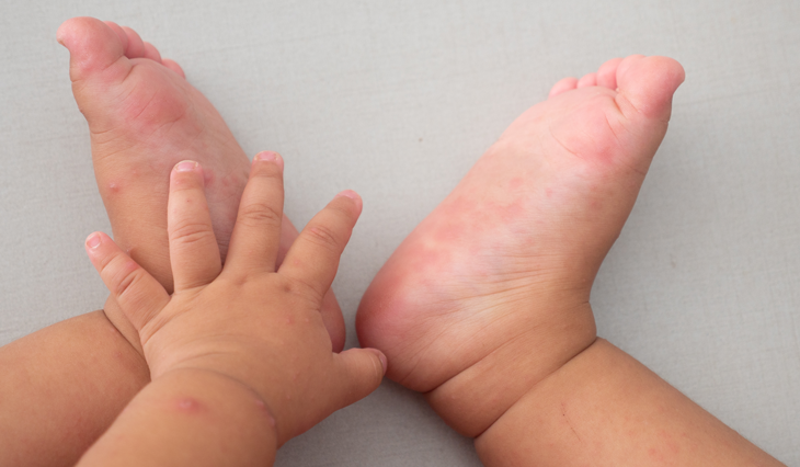 Child Has Blisters On Hands And Feet