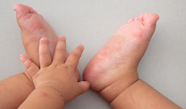 Hand Foot And Mouth Disease In Children HSE ie