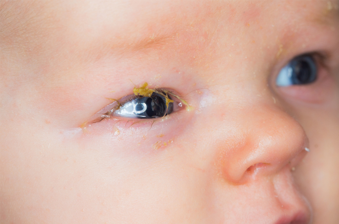 Conjunctivitis In Babies And Children Hse Ie