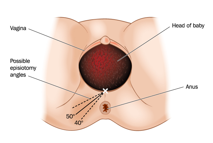 Possible episiotomy angles possible-episiotomy-angles