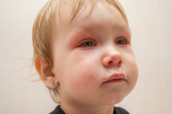 Conjunctivitis In Babies And Children Hse Ie