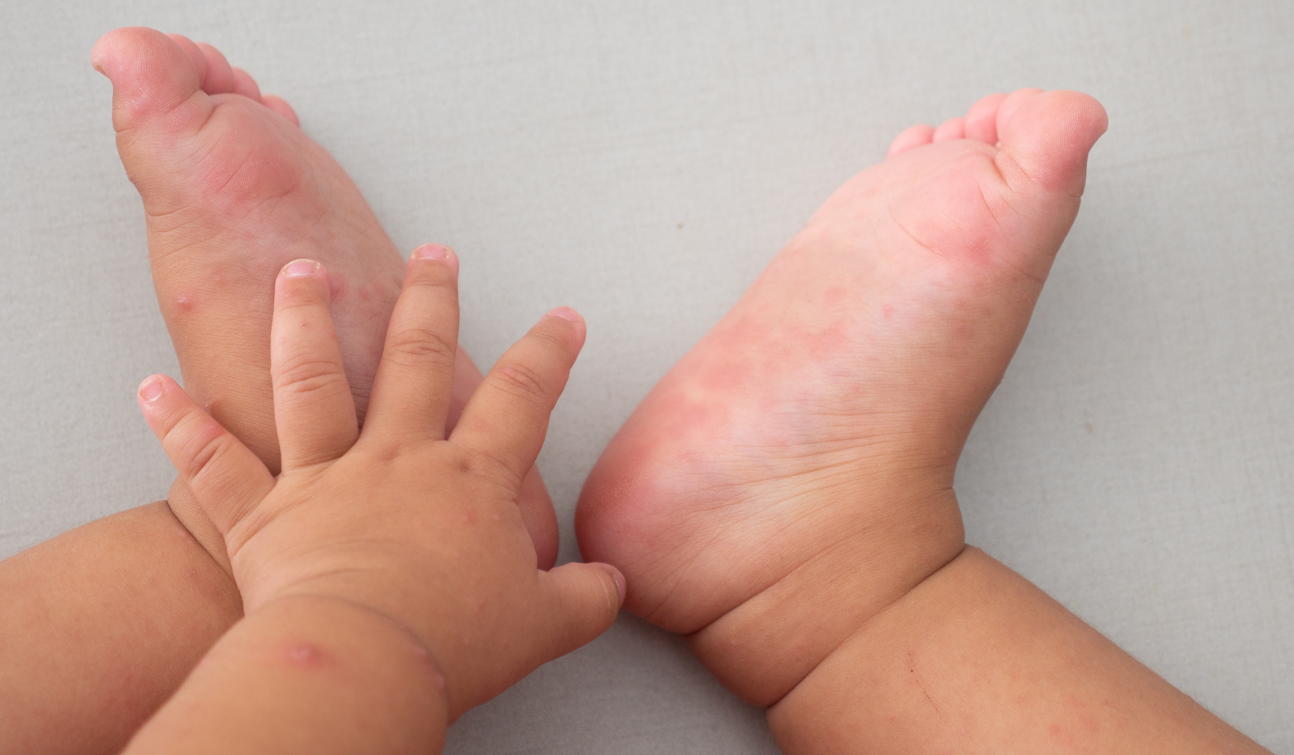 Red spots which develop into blisters usually appear on the hands and feet Red spots which develop into blisters usually appear on the hands and feet