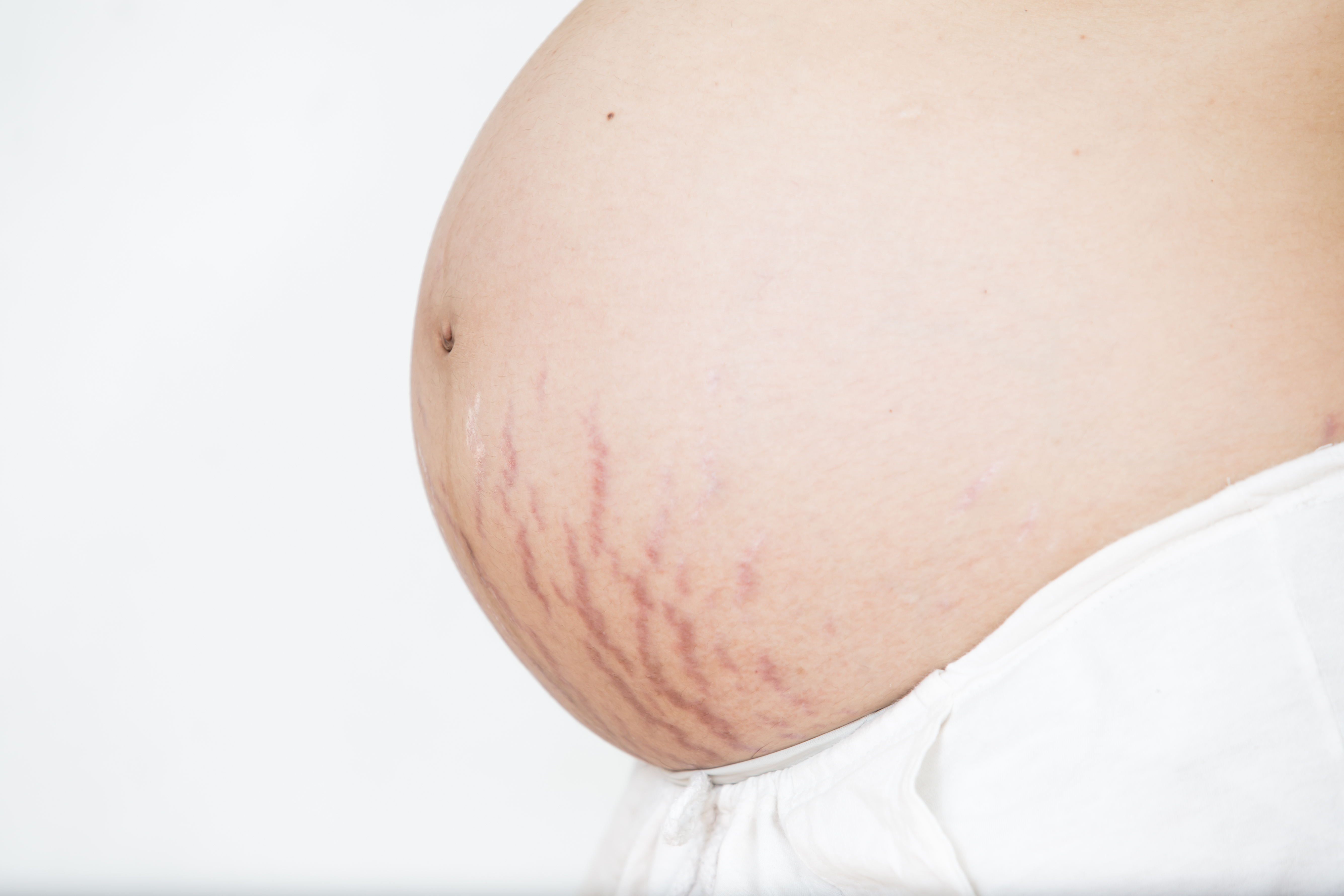 Stretch_marks_on_the_tummy_during_pregnancy Stretch marks on the tummy during pregnancy