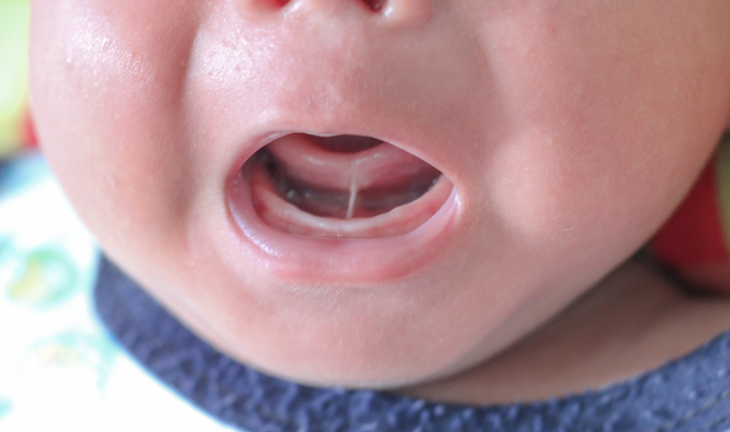 Tongue tie tongue tie