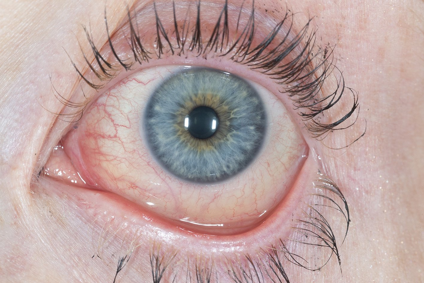 Allergic conjunctivitis Allergic conjunctivitis