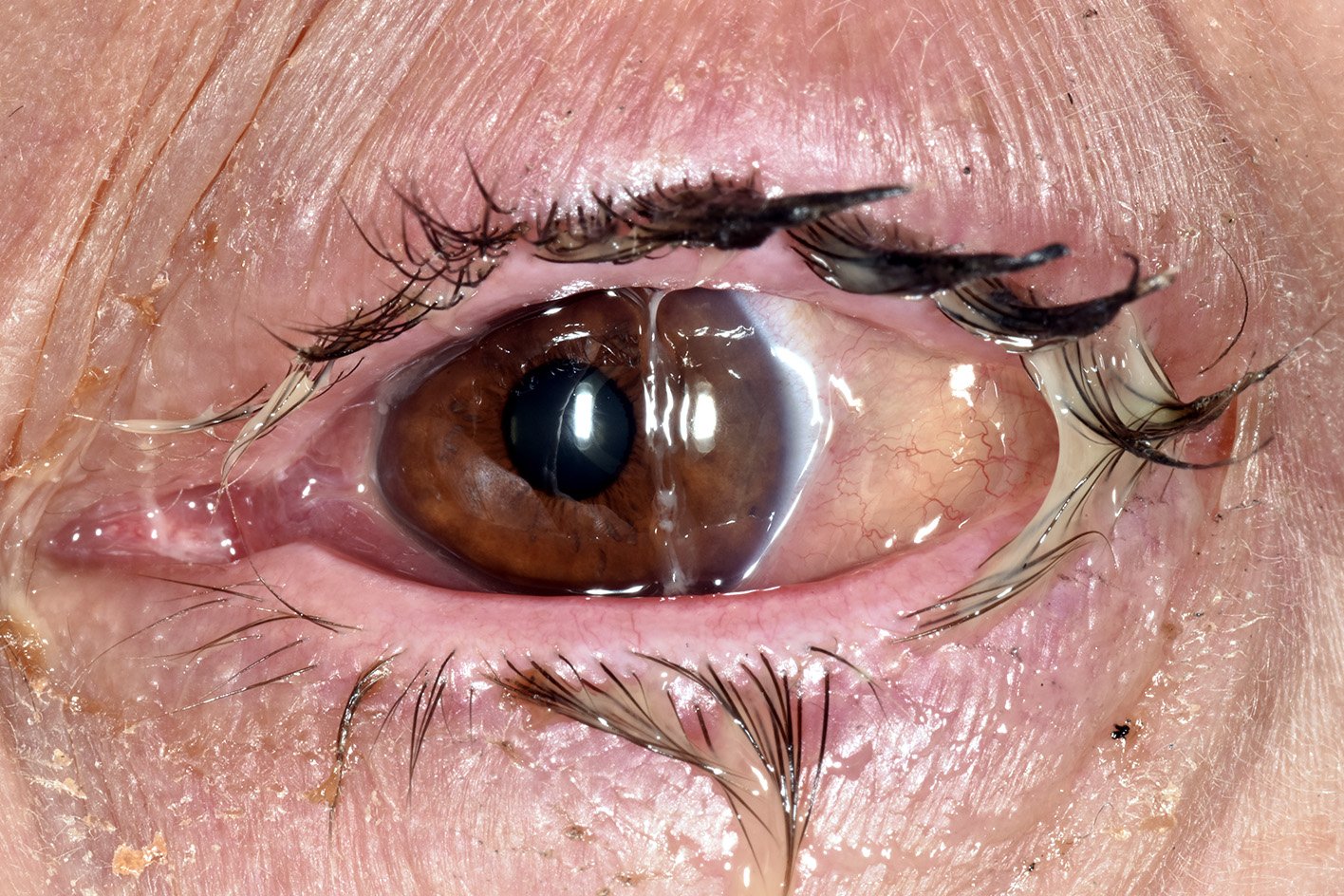 Bacterial conjunctivitis Bacterial conjunctivitis