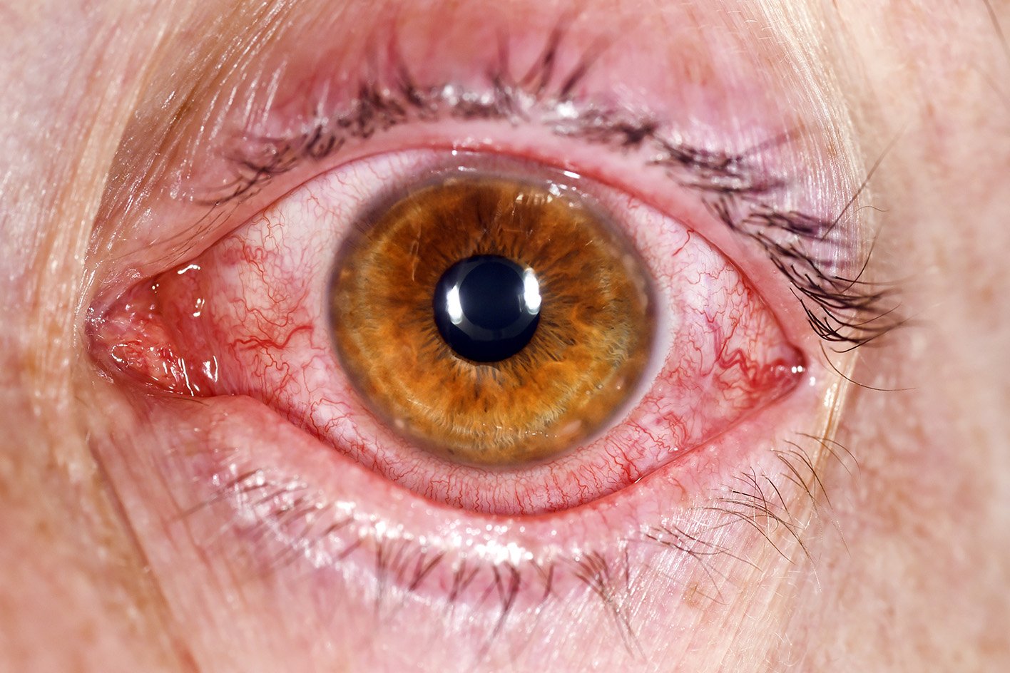 Viral conjunctivitis Viral conjunctivitis