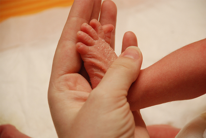 Dry skin - Babies Dry skin - Babies