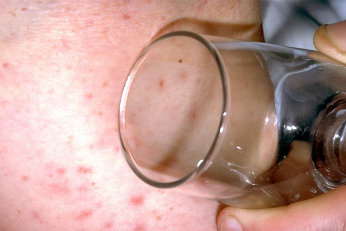 Meningitis tumbler test Meningitis tumbler test