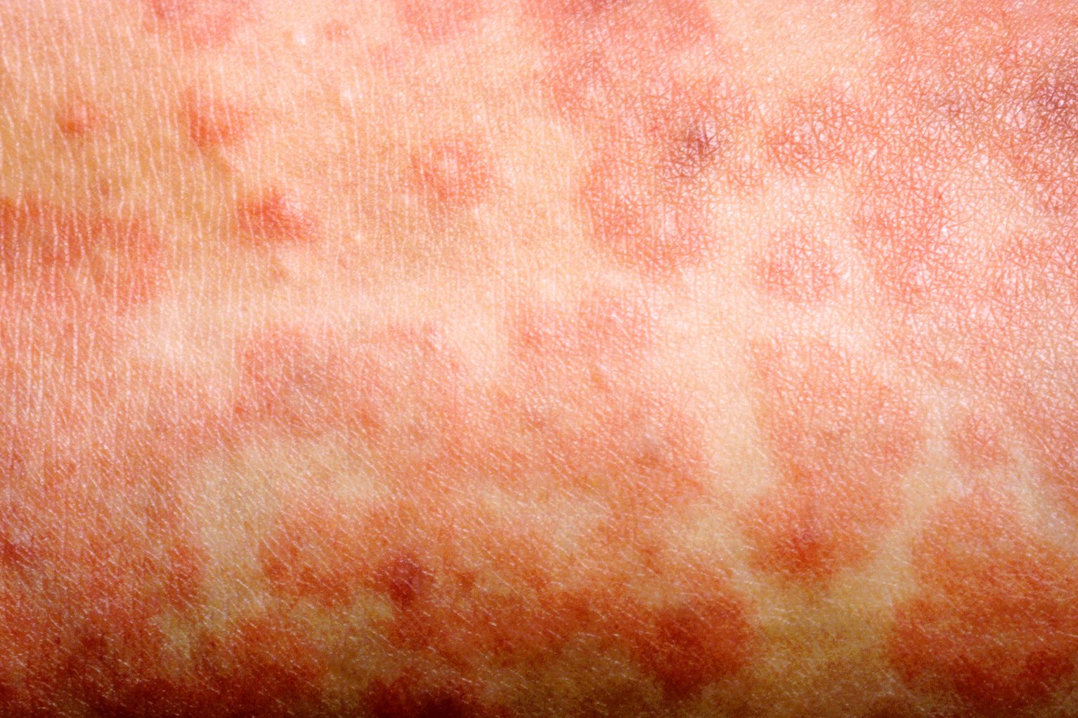 blotchy patches Close-up of skin with a measles rash. The red, raised spots are joined together in blotchy patches