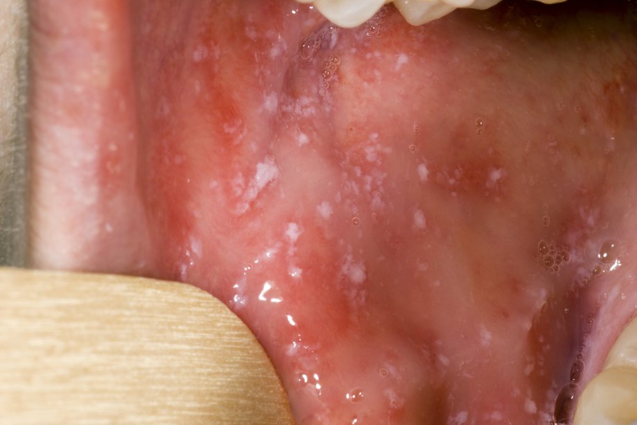 spots in mouth An open mouth with small greyish-white spots on the inside of the cheek