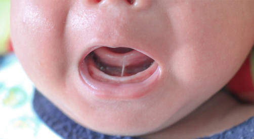 Tongue tie tongue tie