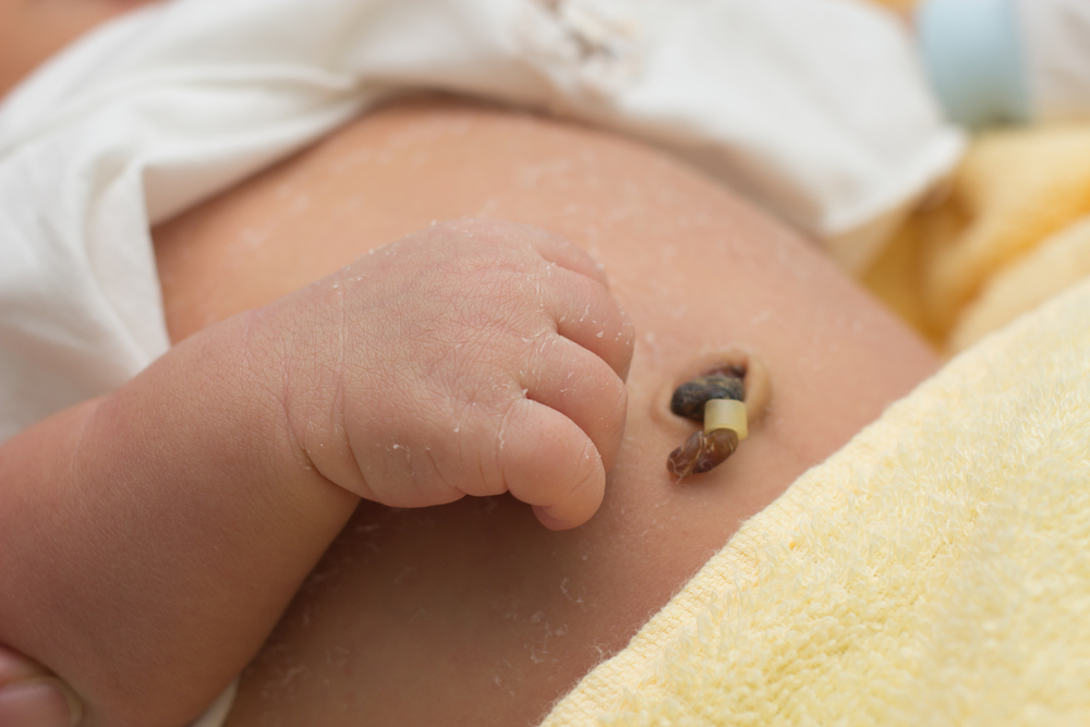 Umbilical cord stump 9 days after birth Umbilical cord stump 9 days after birth