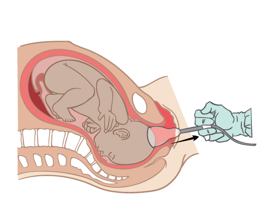 Ventouse birth Ventouse birth