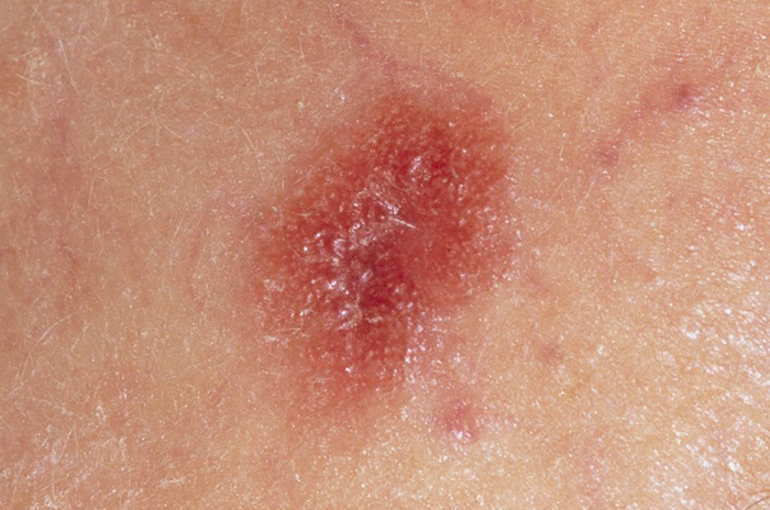 skin-cancer-pictures-most-common-skin-cancer-types-with-images