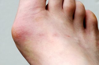 Hard red swollen Hard red swollen