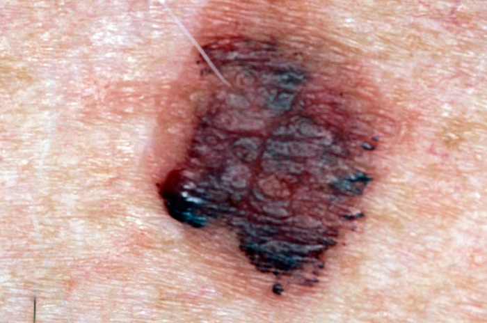 Lentigo maligna melanoma Lentigo maligna melanoma