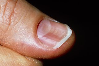 Nail disorder Nail disorder