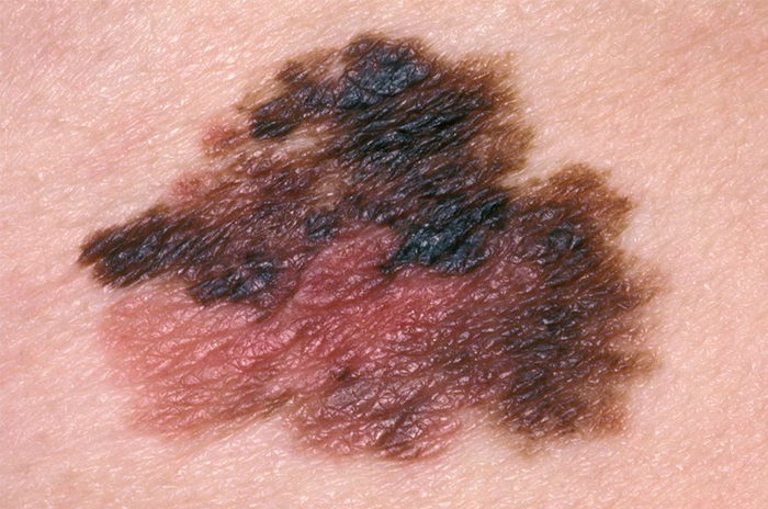 Skin Cancer Melanoma Overview Hseie