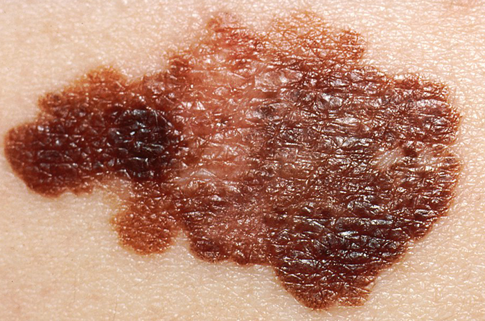 Asymmetrical melanoma Asymmetrical melanoma
