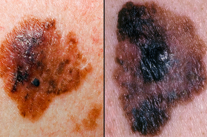 Melanoma border Melanoma border