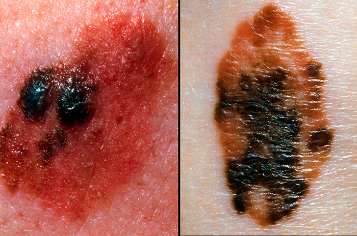 Skin cancer (melanoma) - Symptoms - HSE.ie