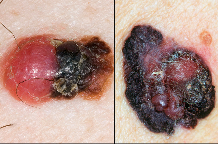 Melanoma elevation Melanoma elevation