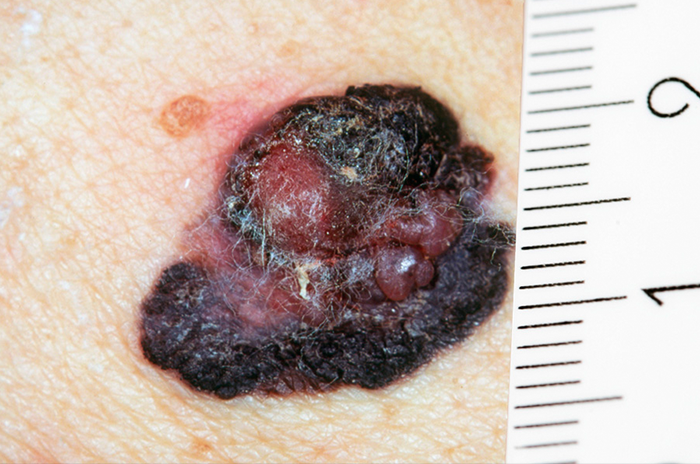 Melanoma size Melanoma size