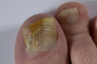 Fungal Nail Infection Hse Ie