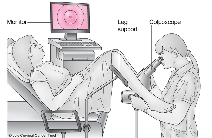 Colposcopy